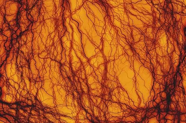 Novas recomendações EULAR para o tratamento das vasculites associadas ao ANCA