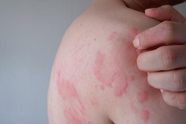 Urticária autoimune em adultos