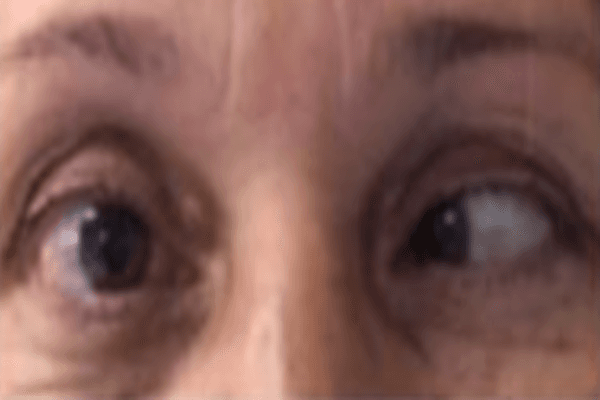 Esotropia associada a uso excessivo da visão de perto durante isolamento social