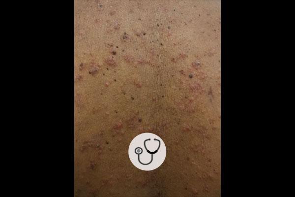 Caso clínico: Lesões eritematosas e edematosas em paciente com psoríase vulgar