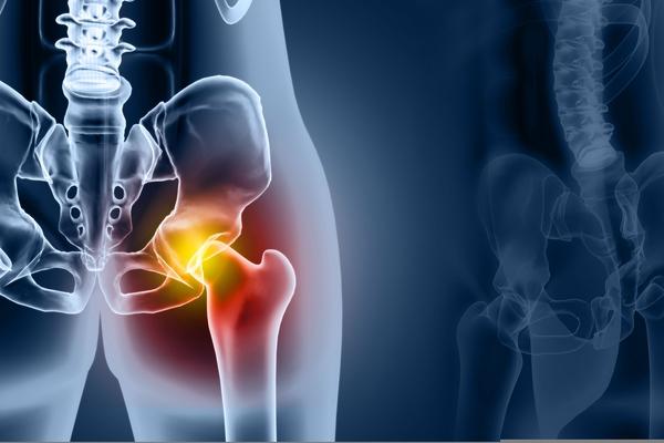Hemiartroplastia, PC ou DHS: qual a melhor em fraturas do colo do fêmur em idosos?