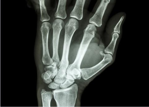 A artrodese total do punho deve ser realizada com ou sem fusão da CMC?