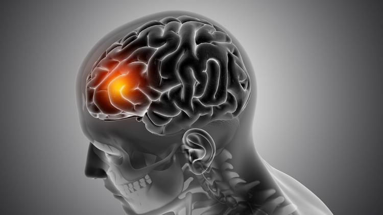 Tratamento de AVC com tenecteplase