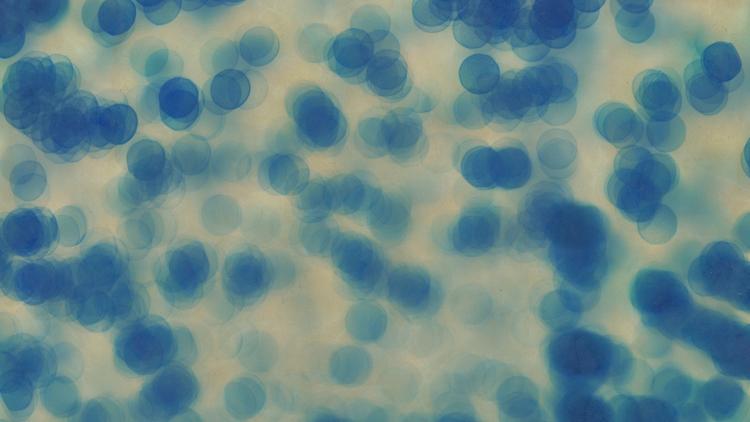 Caracterização de histoplasmose em pacientes sem infecção pelo HIV