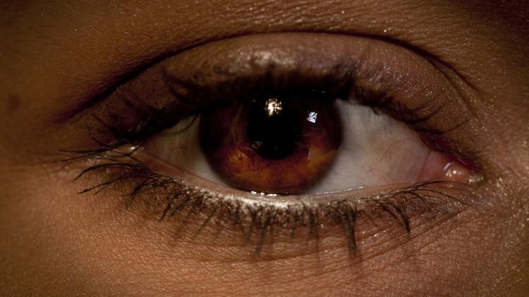 O que você precisa saber sobre neoplasia escamosa da superfície ocular?