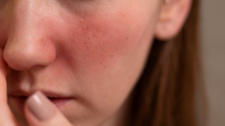 EADV 2024: A nova classificação da rosácea