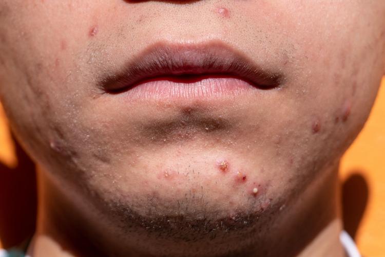 EADV 2024: Hiperpigmentação na acne
