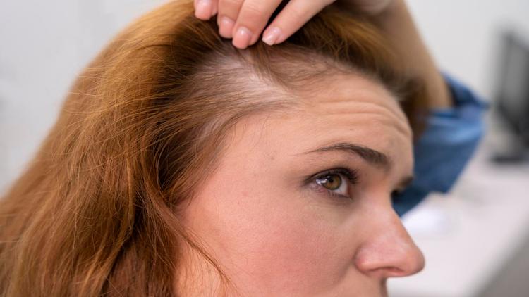 EADV 2024: Tratamento da alopecia areata na era dos inibidores da JAK