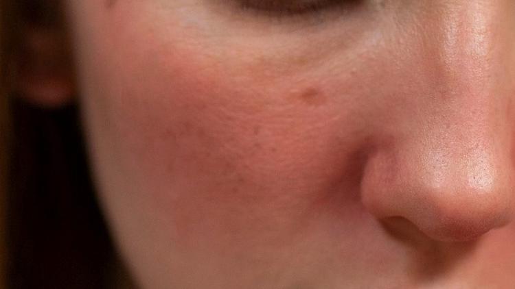 Escarlatina: o que precisamos saber?