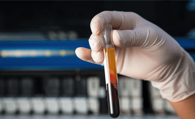 Qual o melhor método para dosar Lipoproteína(a)?