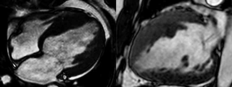 Miocardiopatia hipertrófica e pré-excitação ventricular: qual a relação?