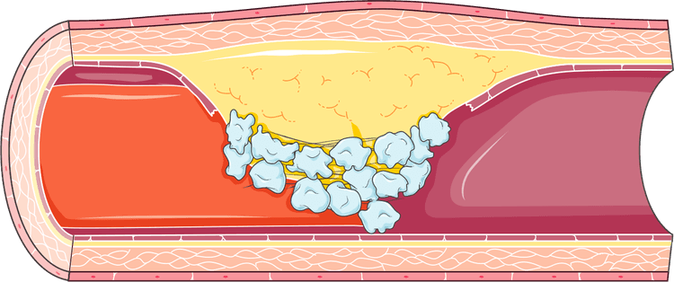 Exite relação entre atividade de placa aterosclerótica e eventos cardiovasculares?
