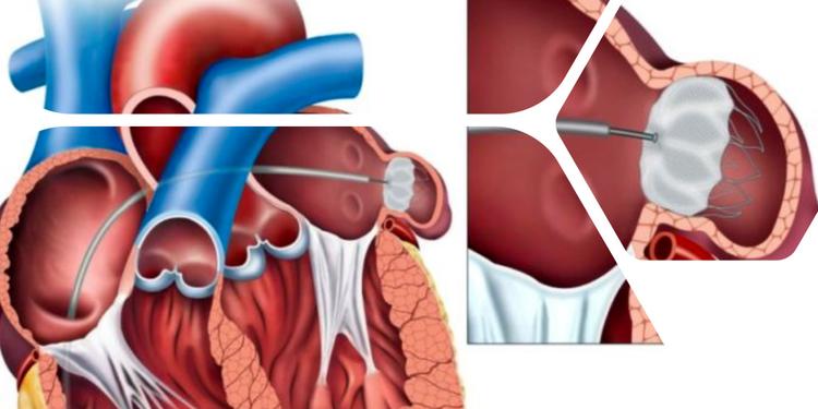 Para Oclusão de Apêndice Atrial Esquerdo, qual prótese devo escolher?