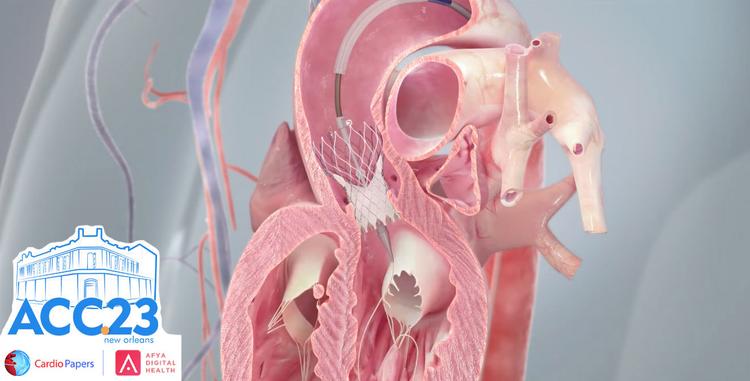 TAVI deve ser a primeira opção em pacientes com EAo de baixo risco cirúrgico?