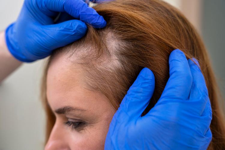 Você conhece a FAPD (Alopecia fibrosante em padrão de distribuição androgenética)?