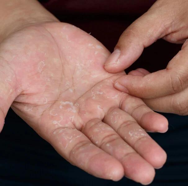 Liquen Plano Palmoplantar: vários espectros clínicos de uma mesma doença