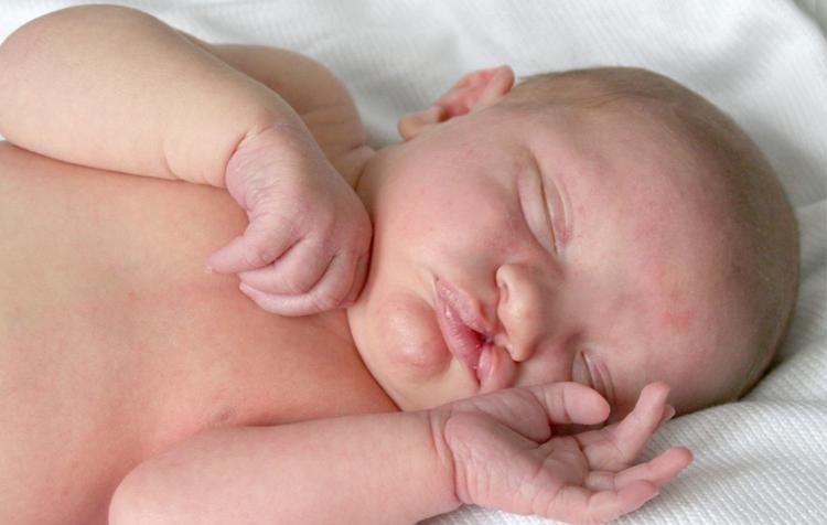 Síndrome de Patau (trissomia do cromossomo 13): Características e Prognóstico