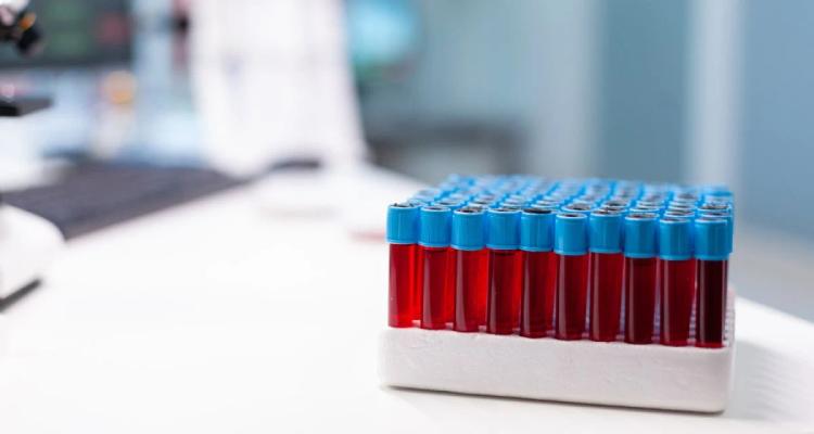 Você sabe quando solicitar exames de triagem lipídica?