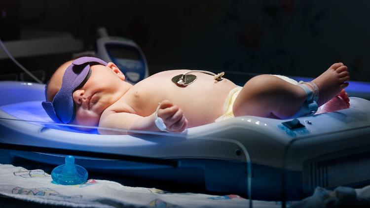 Características da Icterícia Fisiológica Neonatal