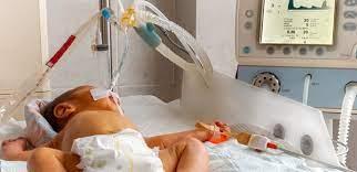 Ventilação de Alta Frequência (VAFO) em Neonatologia