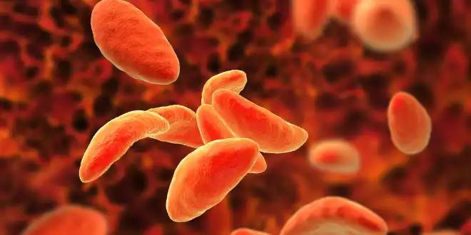 Como interpretar o teste de avidez de IgG para toxoplasmose congênita?