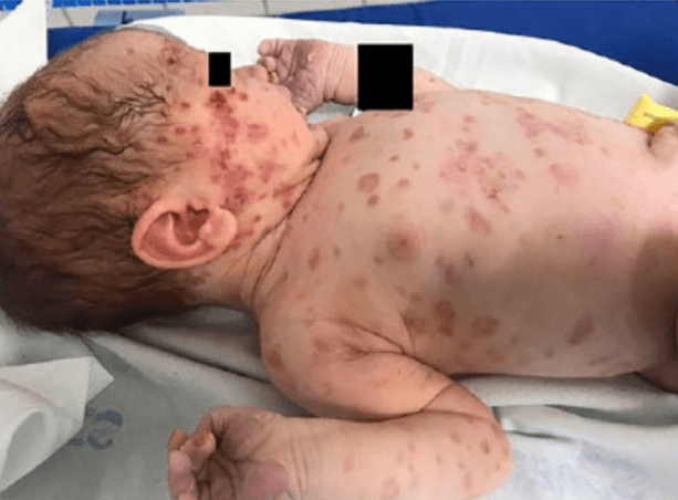 Principais complicações do filho de mãe com anti-Ro/anti-La positivos