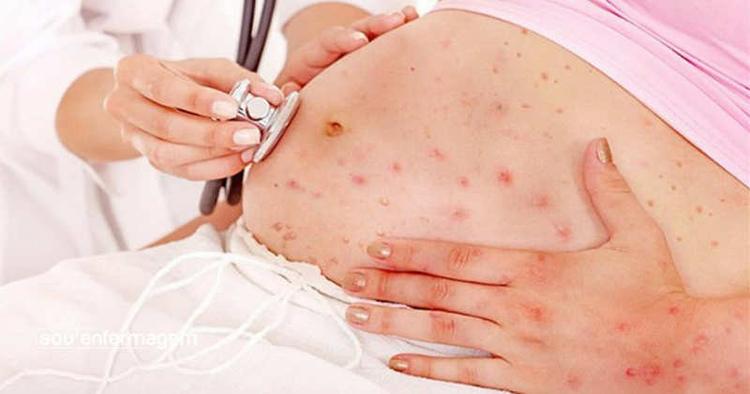 Critérios de mãe adequadamente tratada para sífilis na gestação