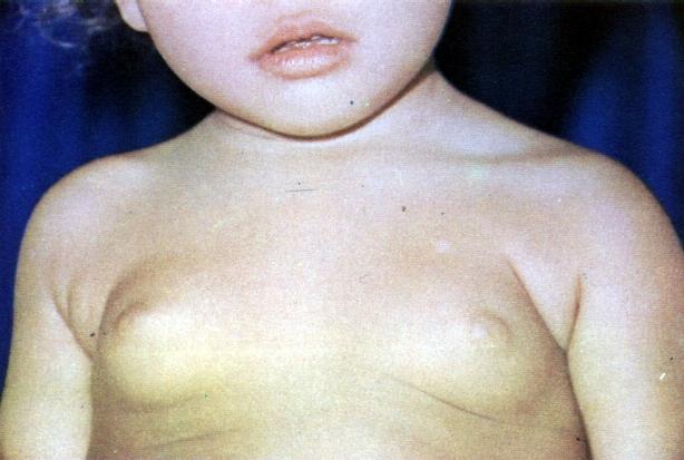 Telarca precoce: o que o pediatra precisa saber!