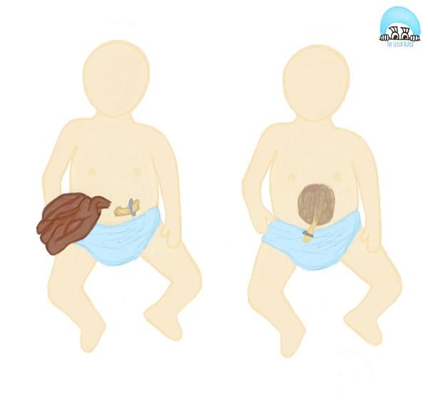 Fatos importantes sobre a onfalocele: