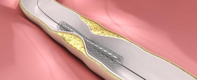 Impacto da sonotrombólise como terapia revolucionária e inovadora na recanalização de IAM