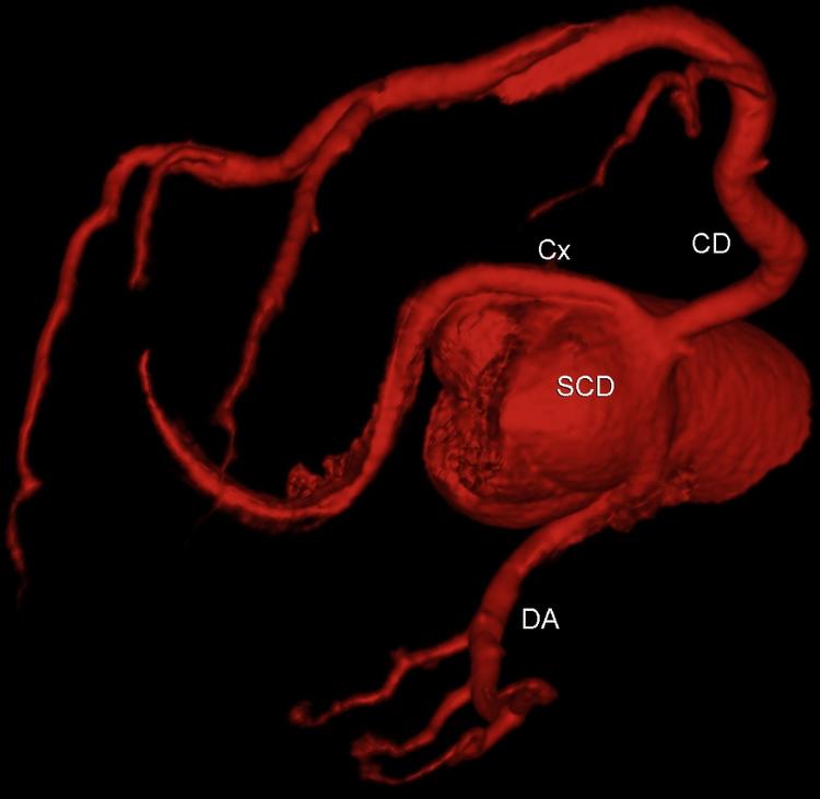 Angiotomografia Coronária é melhor para confirmar ou para excluir coronariopatia?