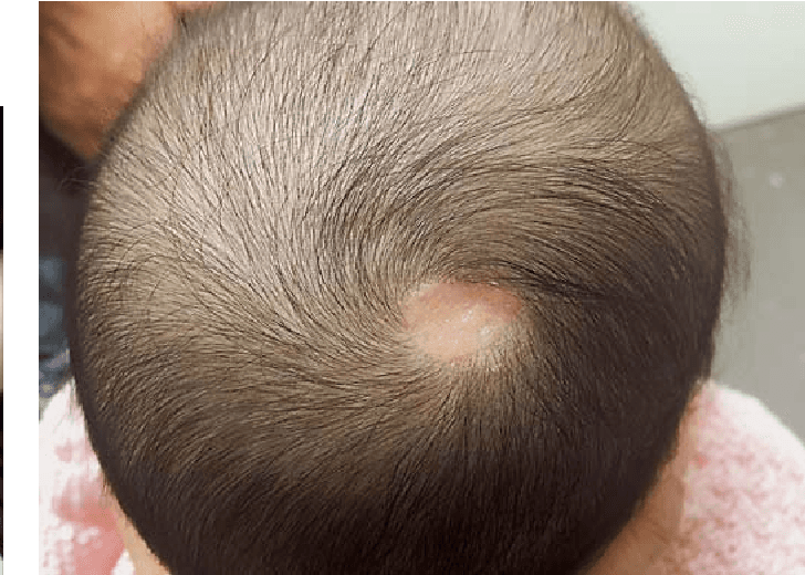 Conhecendo mais sobre a aplasia cútis congênita