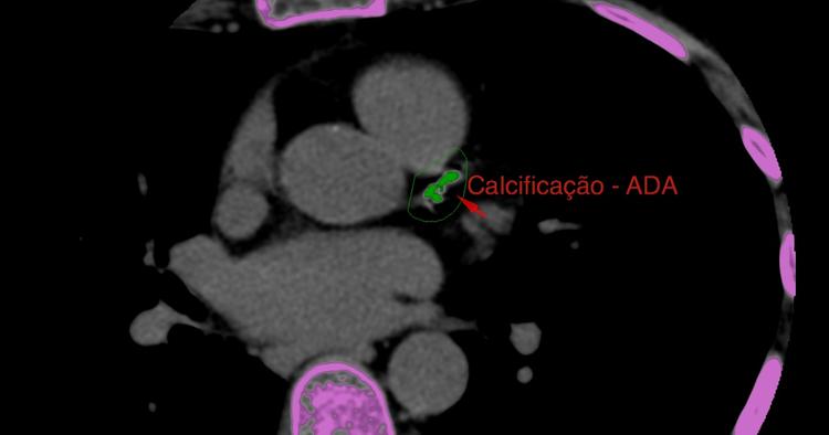 Pedir escore cálcio para paciente diabético faz sentido?