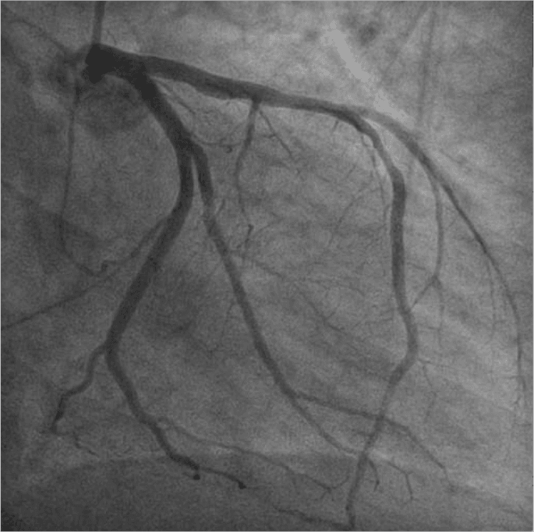 O poder da Troponina ultra-sensível em afastar síndrome coronariana aguda