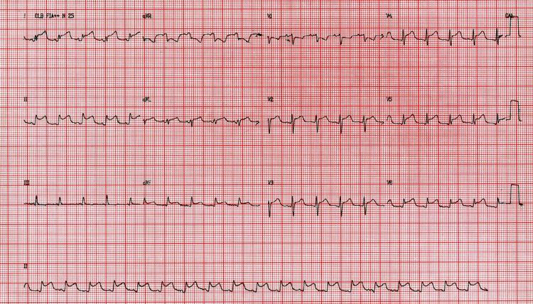 ECG: como diferenciar o supra do infarto do supra da pericardite?
