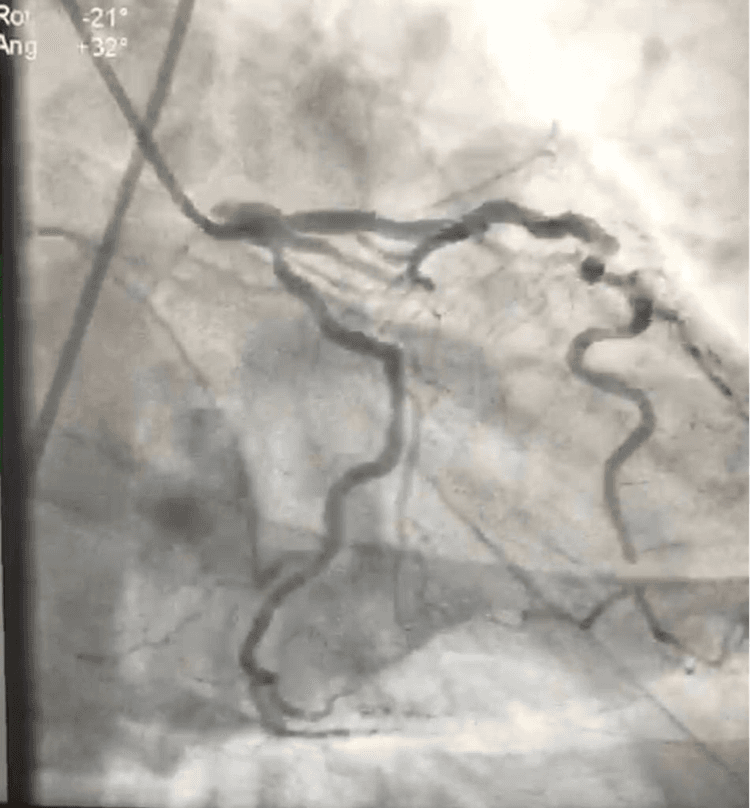 E Agora O Que Fazer Com Essa Paciente Diabetica E Com Sindrome Coronariana Aguda
