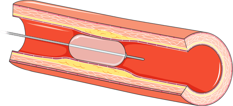 Por que não posso confiar apenas na angiografia para checar resultado de angioplastia?