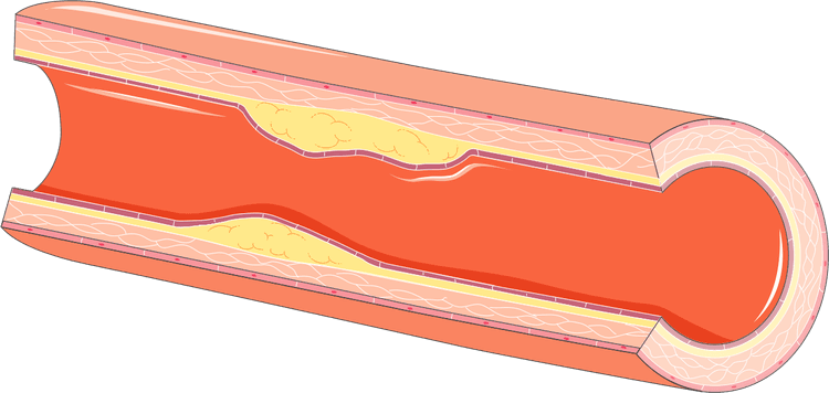 Faz sentido pedir troponina ultrassensível em paciente com dor torácica crônica?