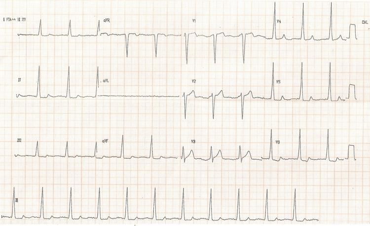 Curso básico de eletrocardiograma – parte 09 – Intervalo PR