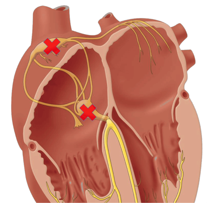 Como reconhecer os diferentes bloqueios atrioventriculares de forma simples?