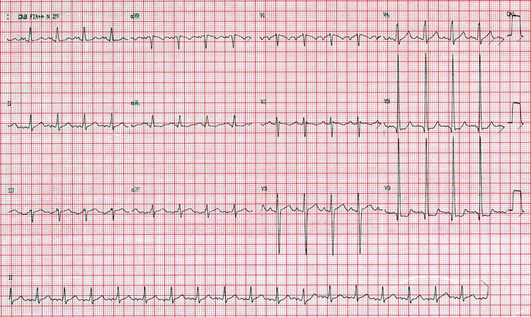 Curso básico de eletrocardiograma – parte 11 – Sobrecargas ventriculares