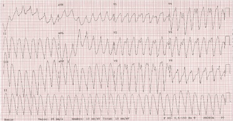 Começa Uma Nova Era na Eletrofisiologia? Ablação não invasiva de taquicardia ventricular!
