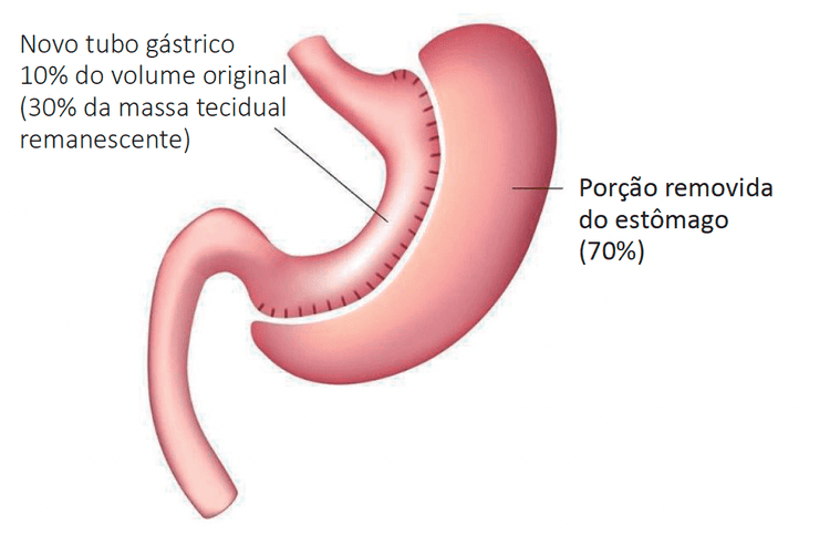 Qual a técnica de cirurgia bariátrica que mais reduz o risco cardiovascular?
