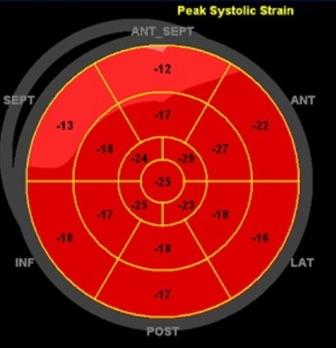 O Strain acrescenta valor prognóstico no pré-op da insuficiência mitral ?