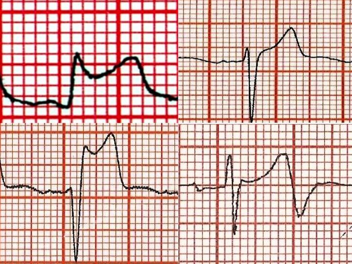 Como medir o supra de ST de forma correta?