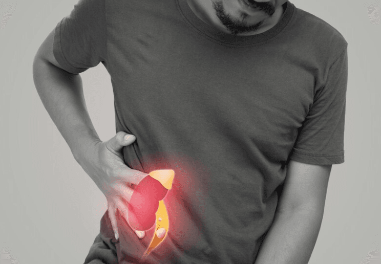 Inibidores de SGLT2 diminuem o risco de nefrolitíase