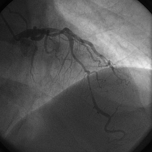 Uso de ultrassom intravascular melhora o resultado de angioplastia?