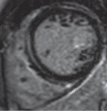 Ressonância Nuclear Magnética Cardíaca e Miocardite pós COVID. Poderia esse método melhorar a capacidade diagnóstica ?