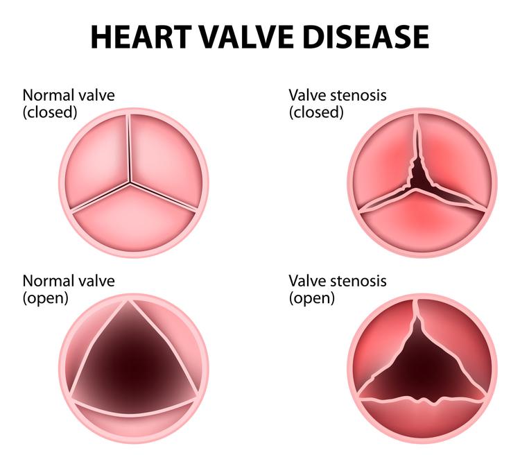 Qual é a relação entre valvopatia degenerativa e diabetes