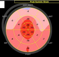 10 dicas sobre Amiloidose Cardíaca que você precisa saber